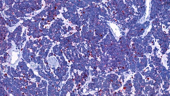 [Translate to Englisch:] Rot eingefärbte, abgestorbene Zellen in DDX1-MYCN co-amplifizierten Neuroblastoma nach einer Rapamycin-Behandlung. Henssen Lab, Max Delbrück Center